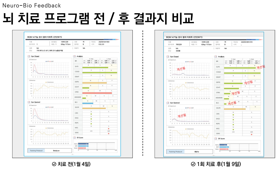 뇌치료 프로그램 전/후 결과지 비교